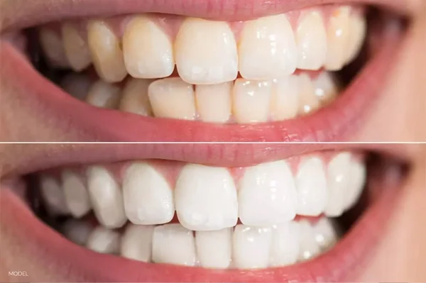 Porcelain Veneers