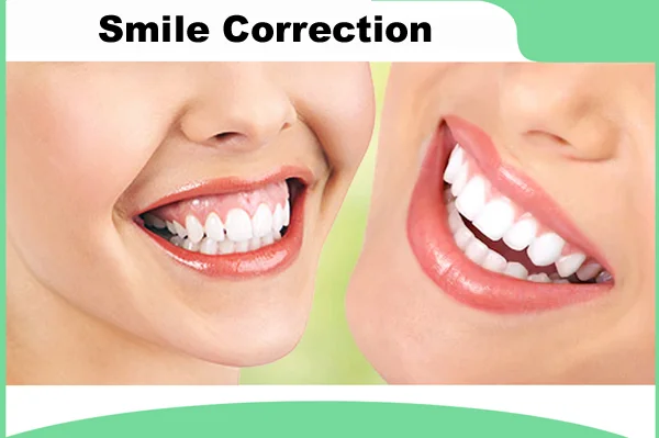 Smile Correction