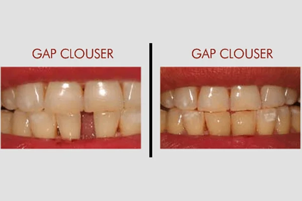 Gap Closure