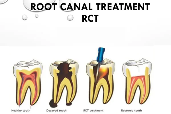 RCT Treatment