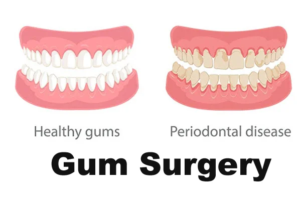 Gum Surgery
